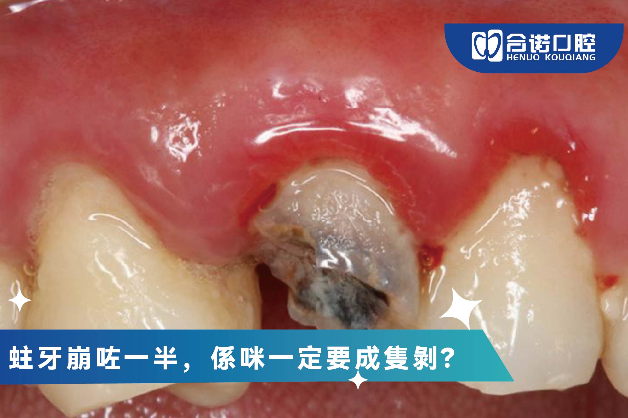 蛀牙崩咗一半，係咪一定要成隻剝？牙醫同你拆解三大關